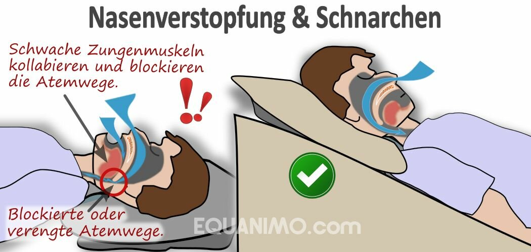 EZsleep Bettkeil fördert bessere Atmung, daher hilft es bei Nasenverstopfung und Schnarchen
